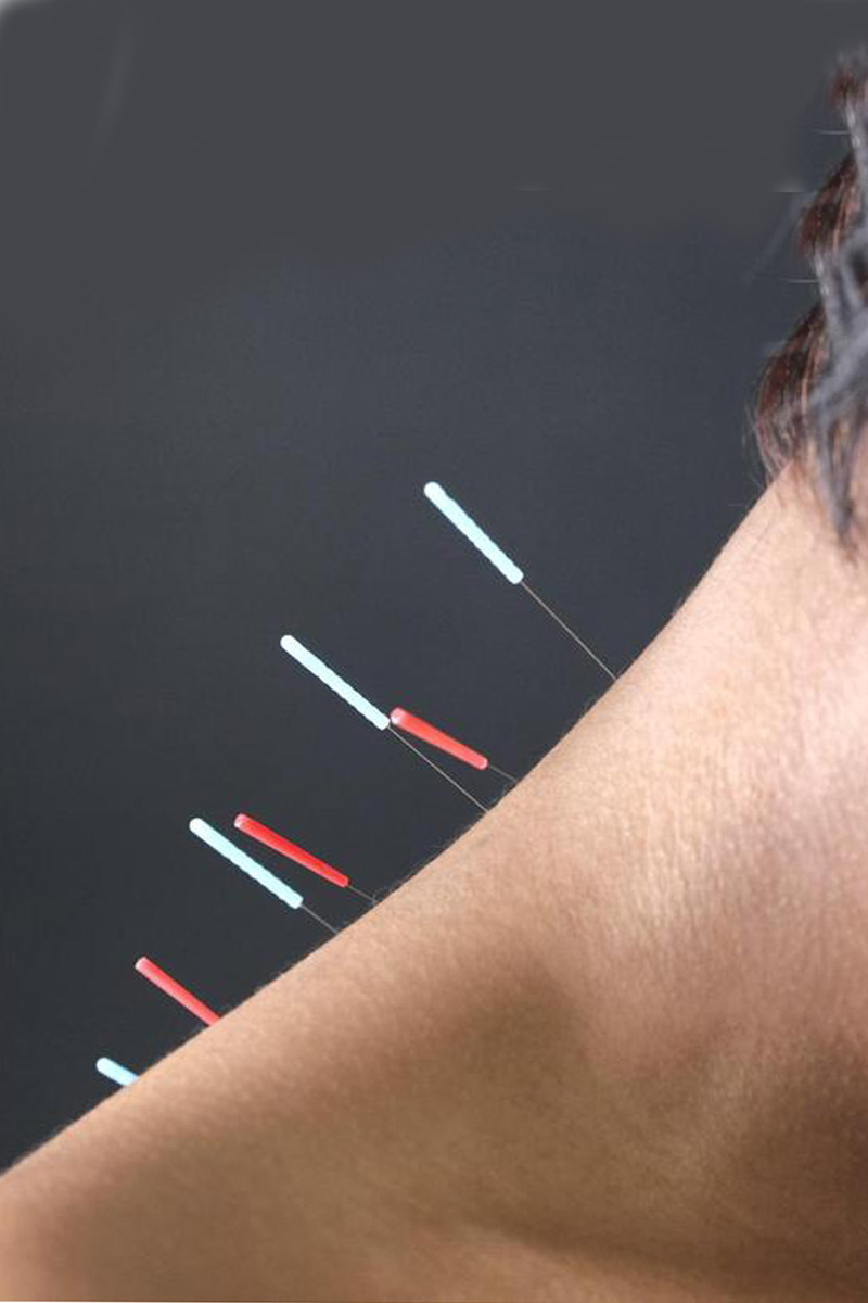Acupuncture Weber Chiropractic Clinic